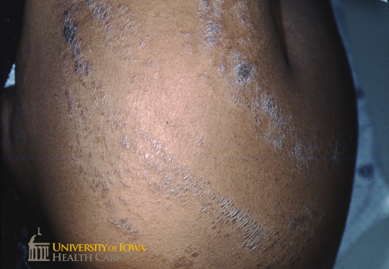 Curvilineal violaceous papules with overlying lacy scale coalescing forming a plaque on the extremity. (click images for higher resolution).